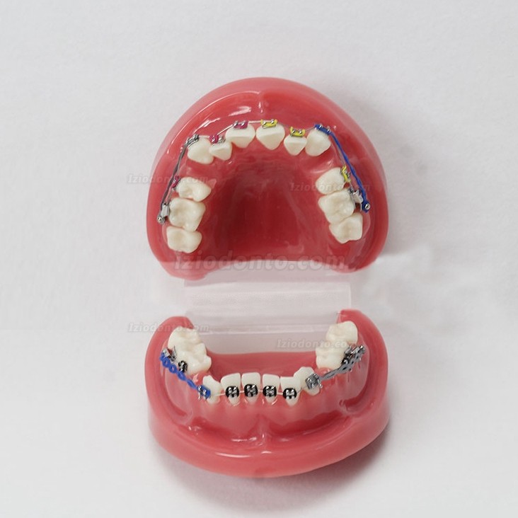 Maloclusão dentária corrigida com suporte dentário modelo padrão M3005