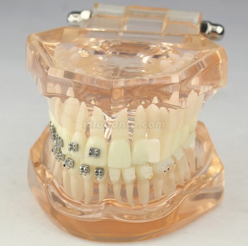 Modelo odontológico ortodôntico com suportes cerâmicos M3009