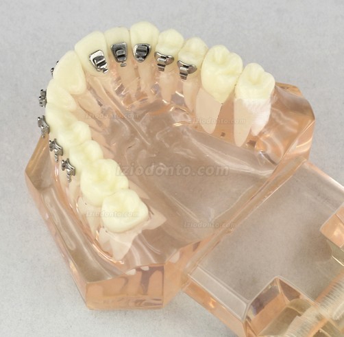 Modelo odontológico ortodôntico com suportes cerâmicos M3009