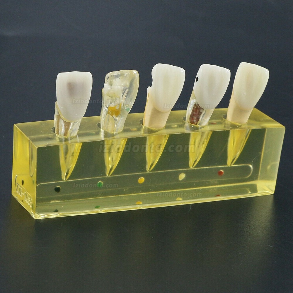 Dentes dentais modelo 5 estágios demonstração tratamento endodôntico incisivo do canal radicular