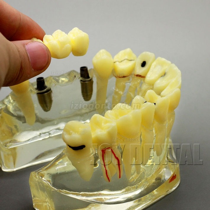 Restauração dentária ampliada / prótese / modelo de estudo de implante com ponte