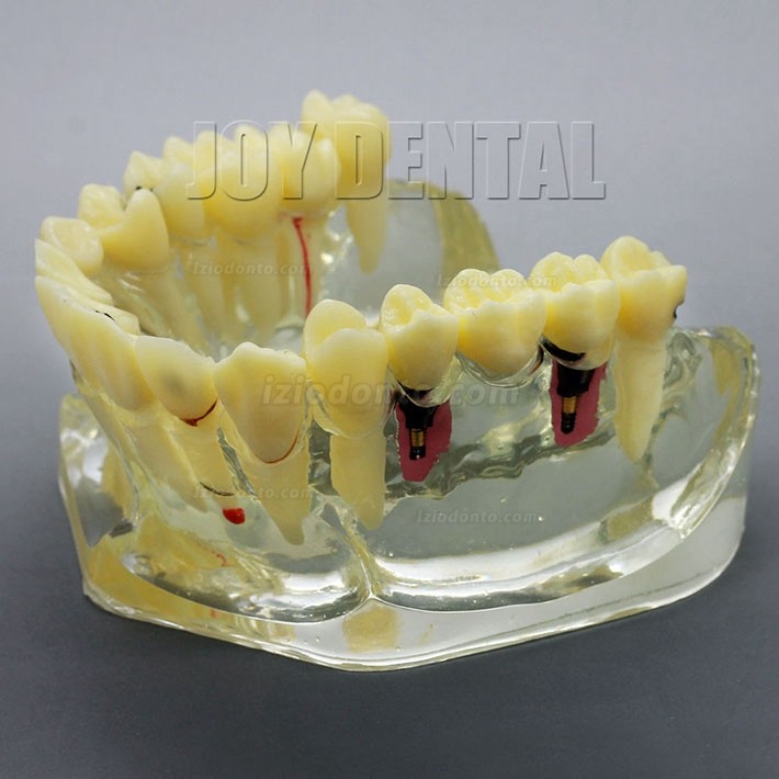 Restauração dentária ampliada / prótese / modelo de estudo de implante com ponte