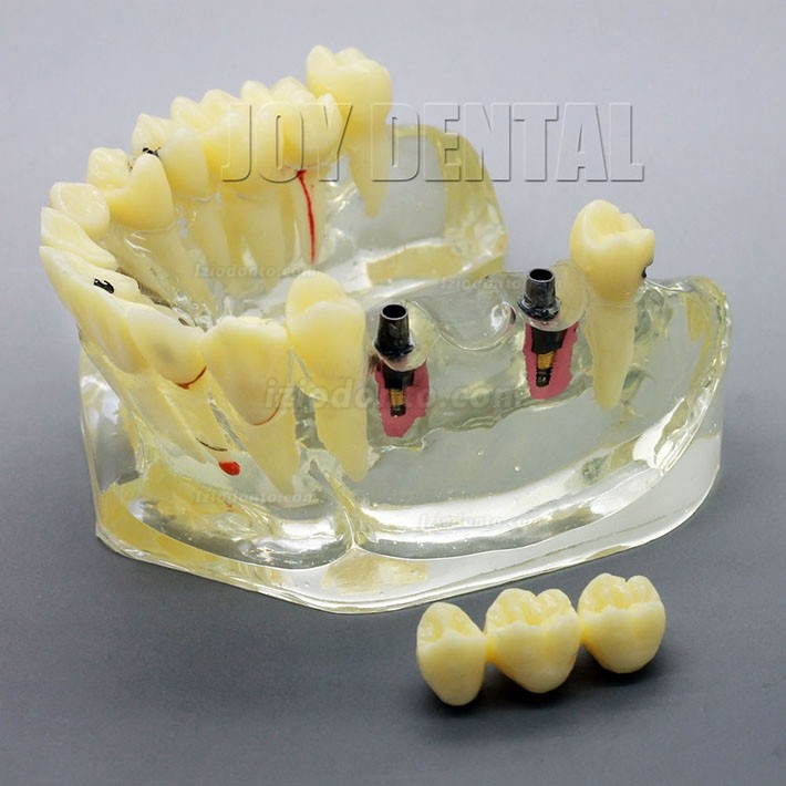 Restauração dentária ampliada / prótese / modelo de estudo de implante com ponte