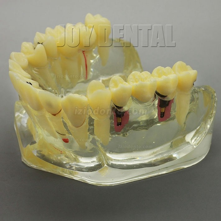 Restauração dentária ampliada / prótese / modelo de estudo de implante com ponte