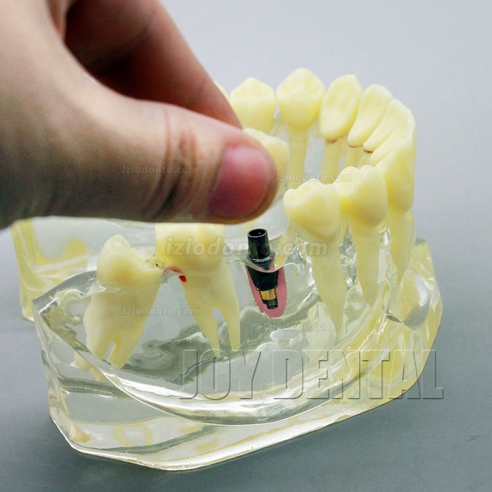 Restauração dentária ampliada / prótese / modelo de estudo de implante com ponte