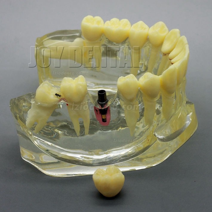 Restauração dentária ampliada / prótese / modelo de estudo de implante com ponte