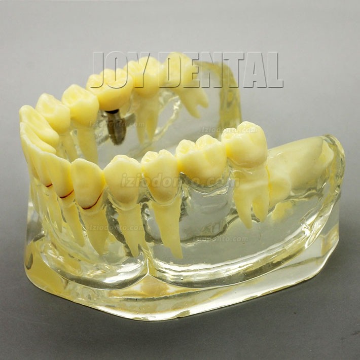 Restauração dentária ampliada / prótese / modelo de estudo de implante com ponte