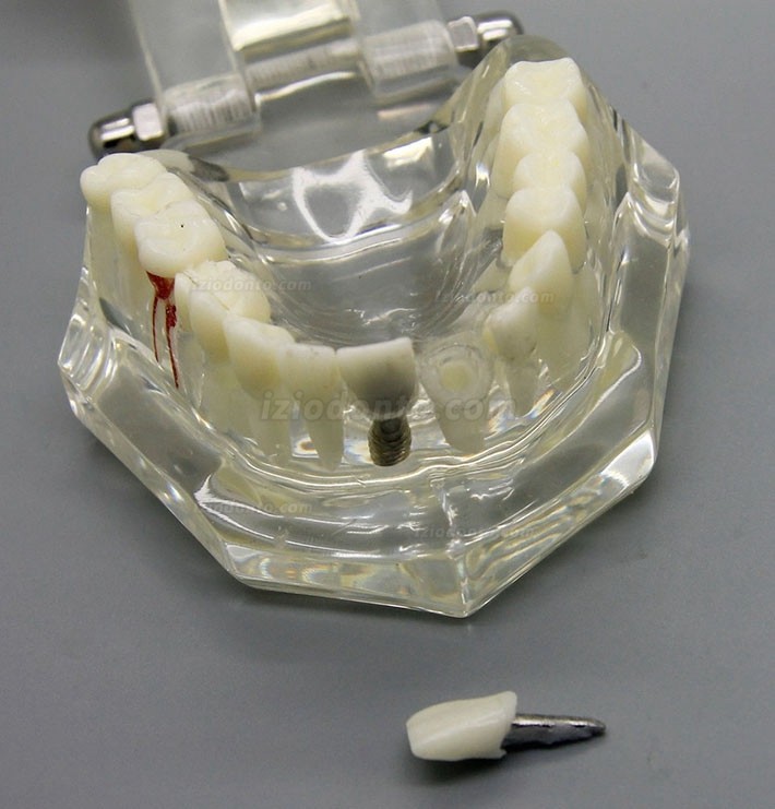 Demonstração de análise de estudo de implante dentário Modelo de doença dentária com restauração