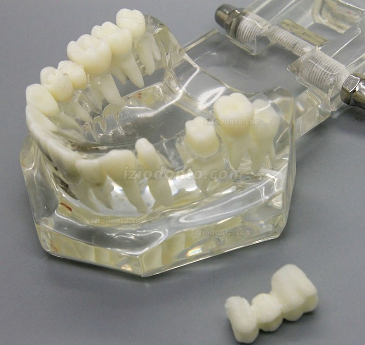 Demonstração de análise de estudo de implante dentário Modelo de doença dentária com restauração