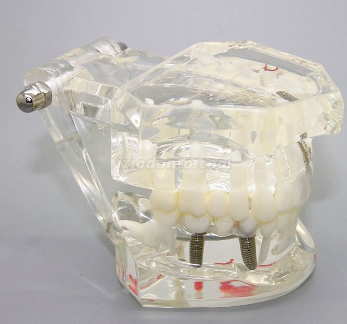 Demonstração de análise de estudo de implante dentário Modelo de doença dentária com restauração