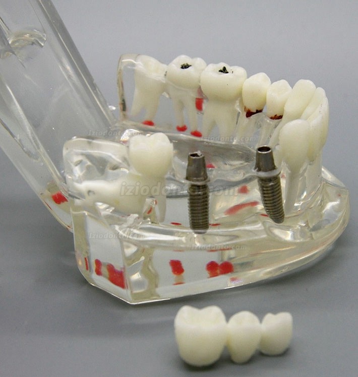 Demonstração de análise de estudo de implante dentário Modelo de doença dentária com restauração