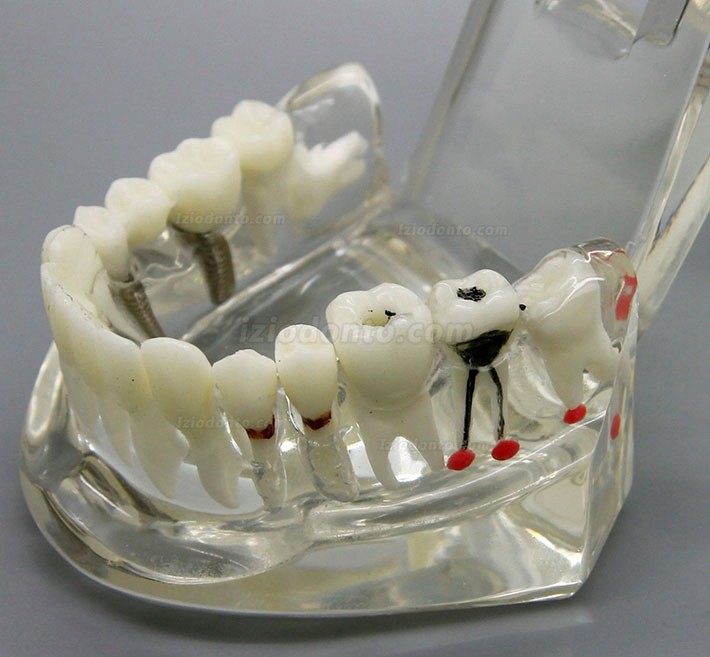 Demonstração de análise de estudo de implante dentário Modelo de doença dentária com restauração