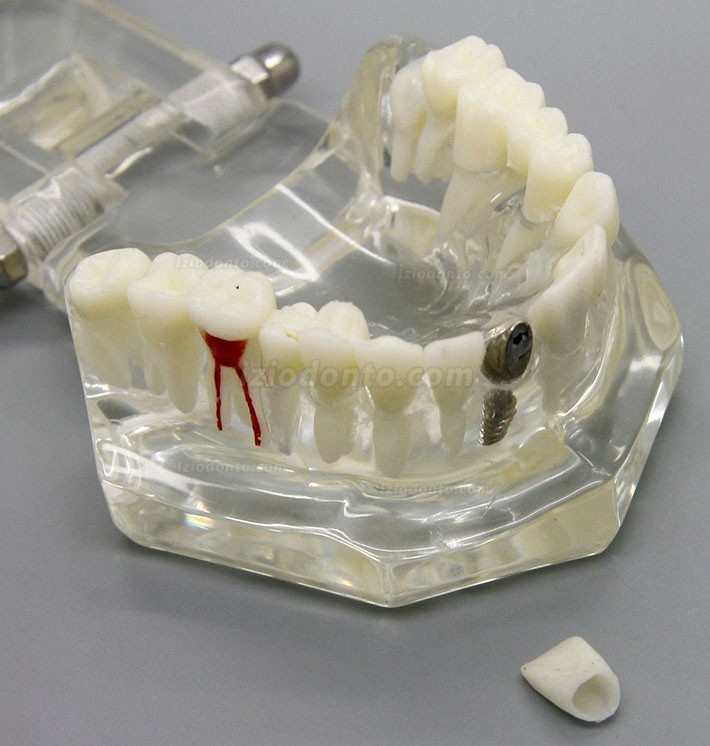 Demonstração de análise de estudo de implante dentário Modelo de doença dentária com restauração